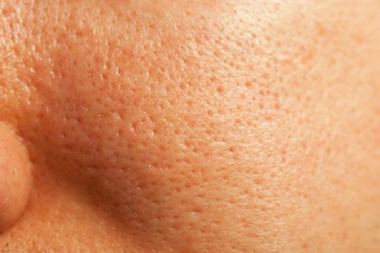 Treatment of pores