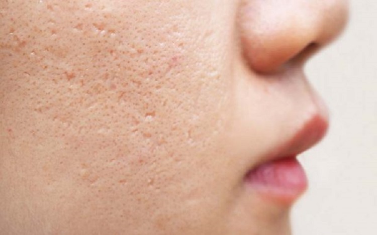 Treatment of pores