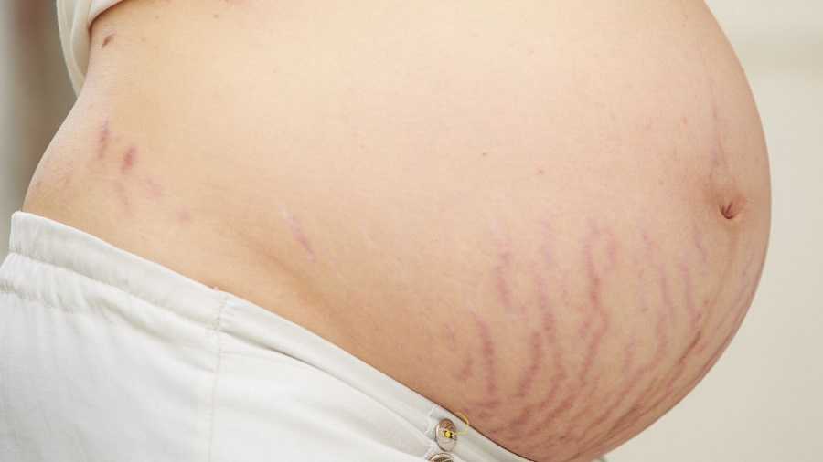 Pregnancy skin rupture