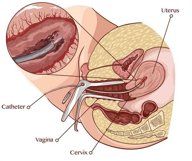 Endometrial scratch