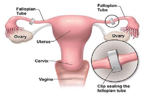 Uterine tubes in women