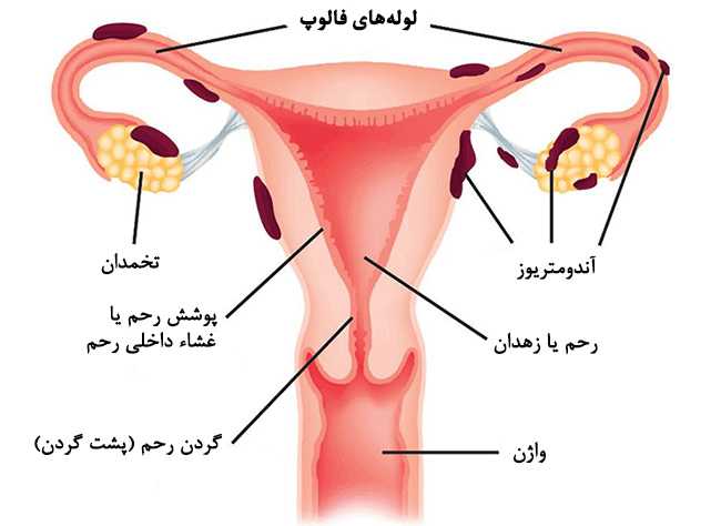 GIFT treatment of infertility