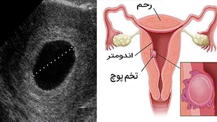 Molar pregnancy