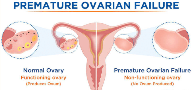 Premature ovarian failure