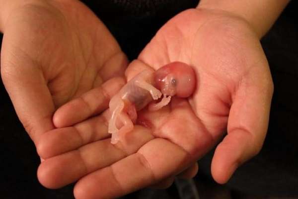 سقط عمدی جنین