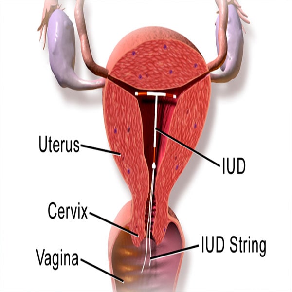 Pregnancy of women with iud