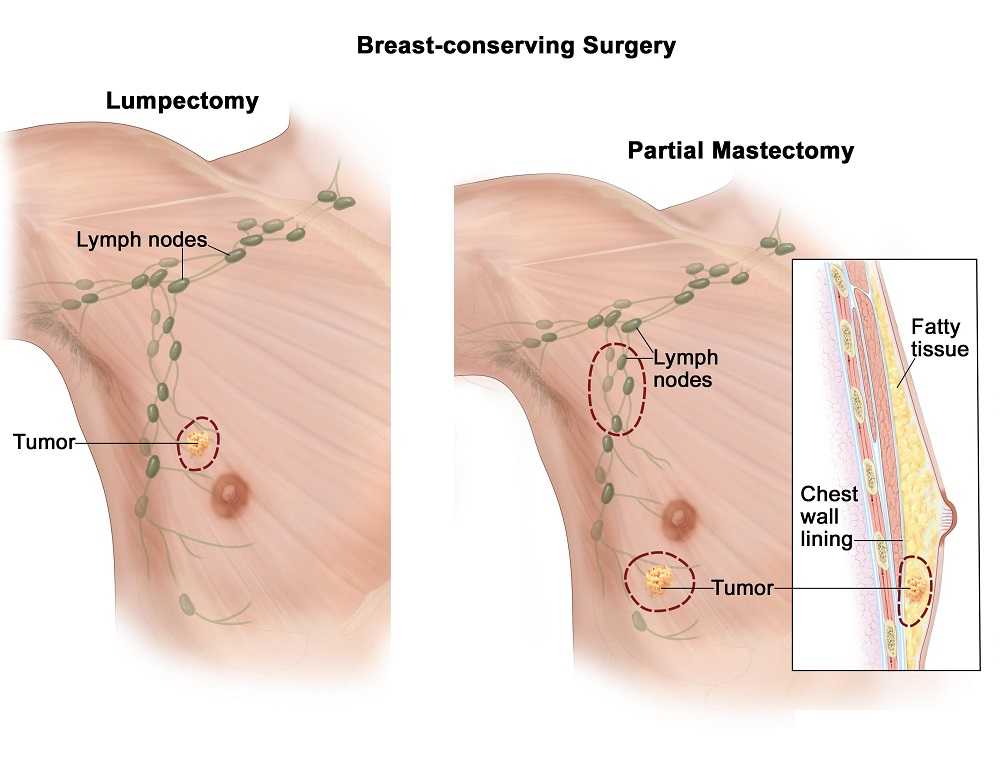 Breast cysts