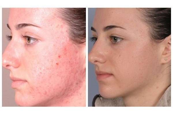 Microdermabrasion to remove pimples