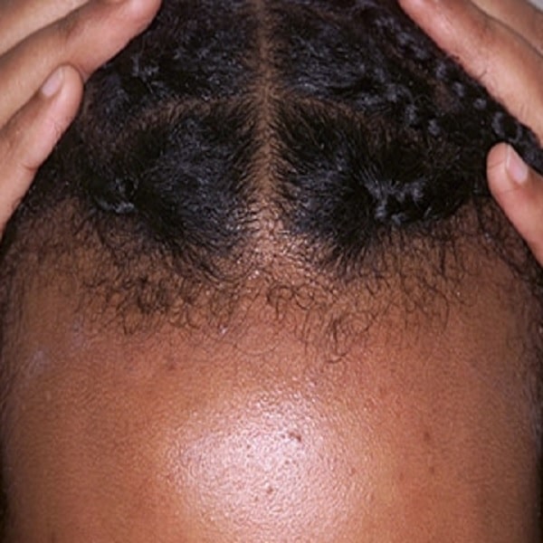درمان ريزش مو در زنان